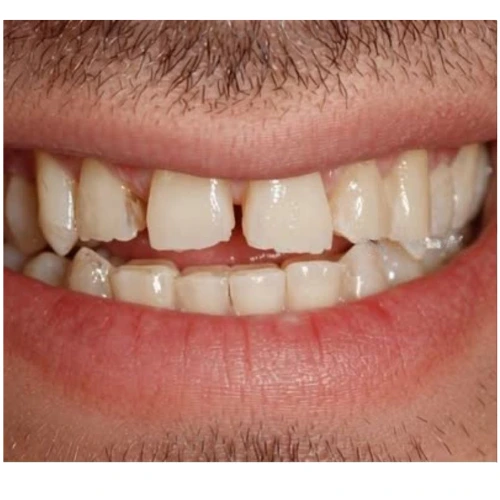 Antes - Carillas dentales