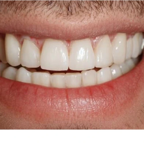 Después - Carillas dentales