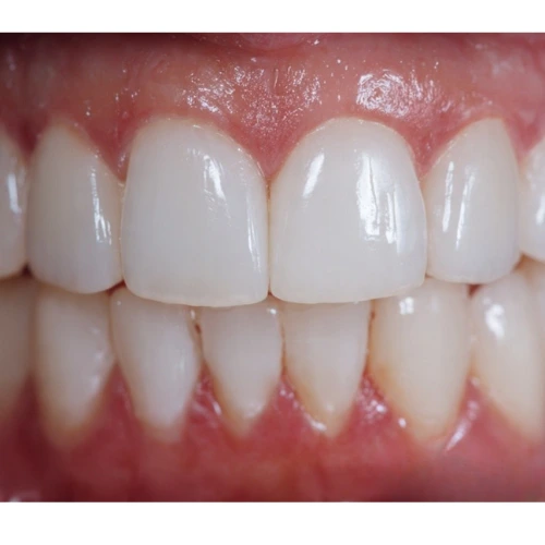 Después - Carillas dentales